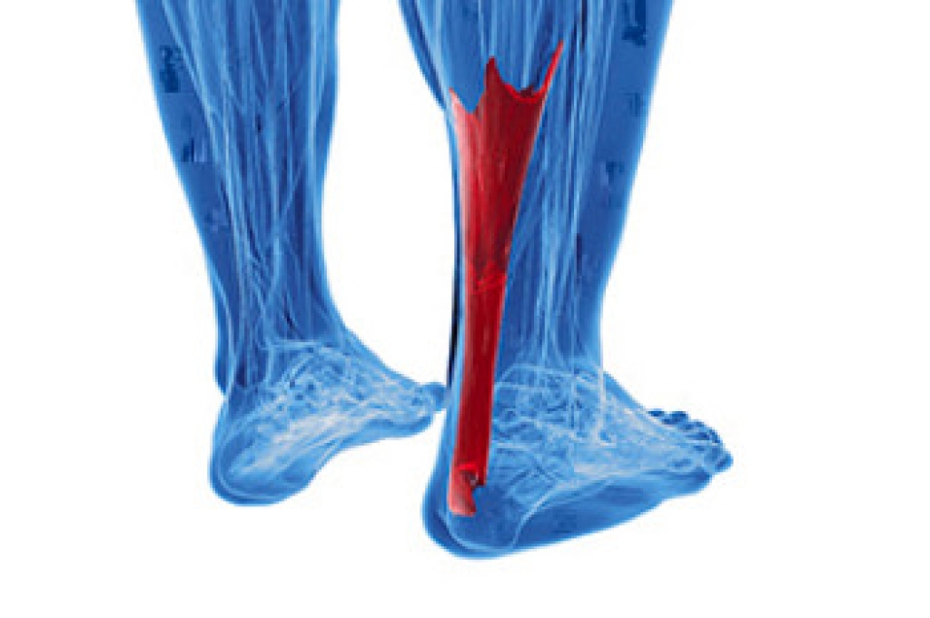 How Podiatrists Treat Achilles Tendonitis