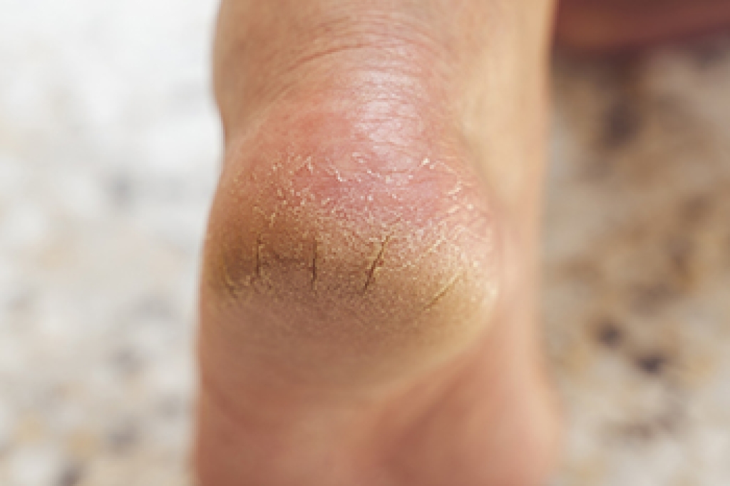 Dry Skin Can Become Painful Cracked Heels
