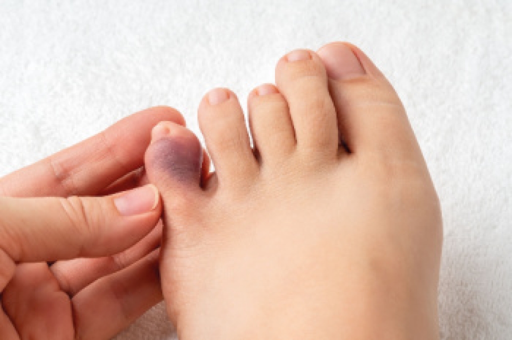 Broken Toe Facts