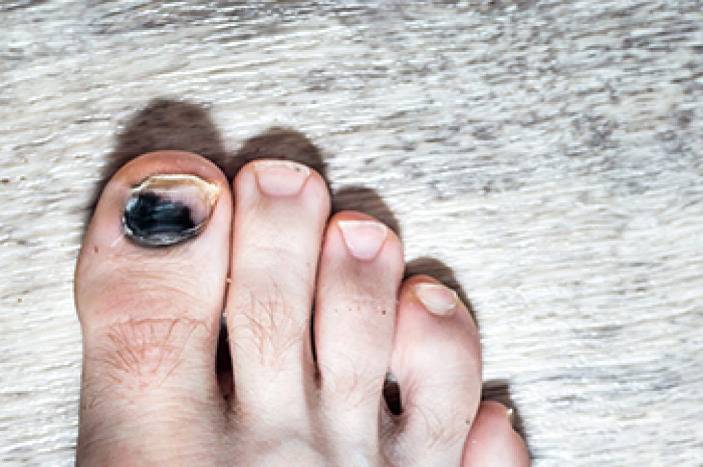 What Causes a Black Toenail?