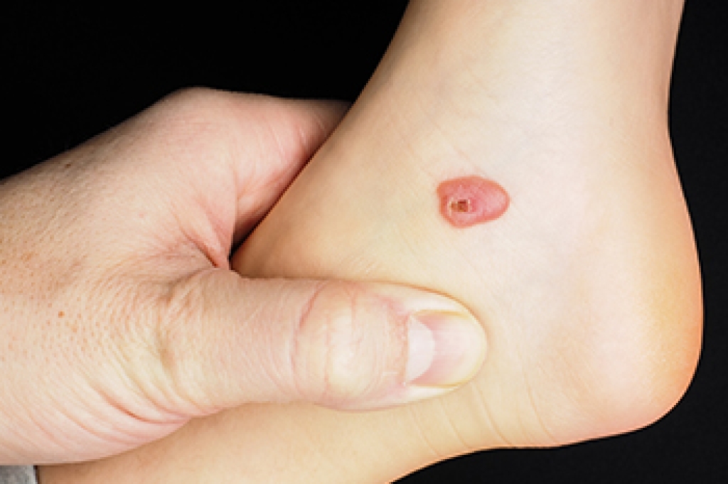 When a Foot Blister Turns Serious