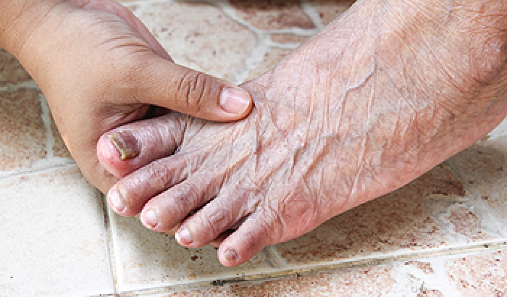 Recognizing Toenail Fungus Infections