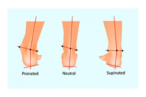 Overpronation and Risk of Injuries