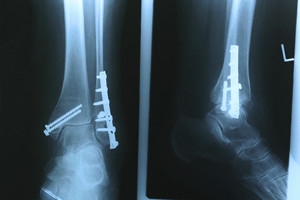 ORIF for an Ankle Fracture